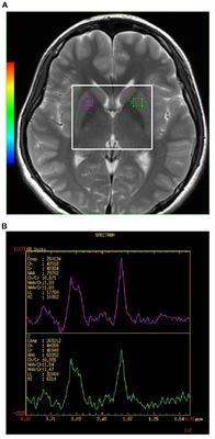 Interaction of Serum Copper and Neurometabolites on Executive Dysfunction in Unmedicated Patients With Major Depressive Disorder